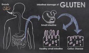 celiac disease